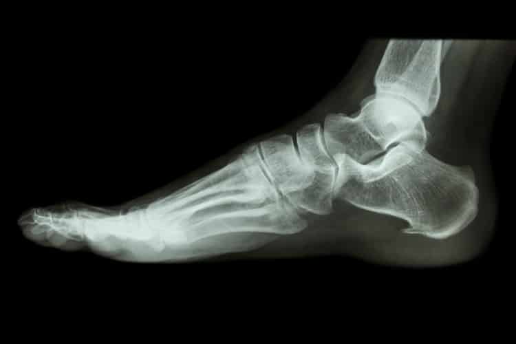 Injury Attorneys Help Victims Of Bone Fractures Other Injuries